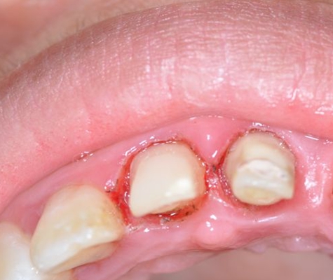 牙根疮的症状图片图片