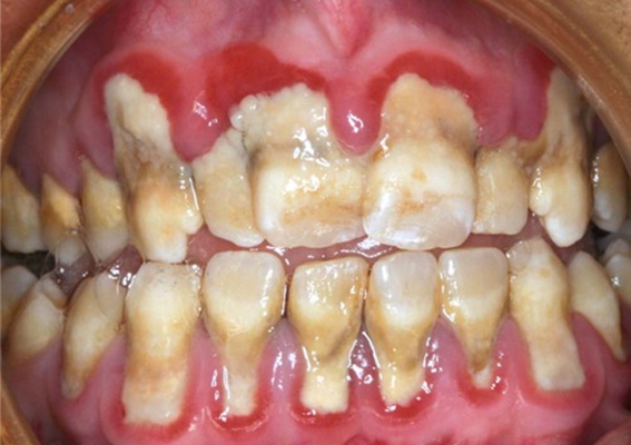 牙菌斑牙齿图片33