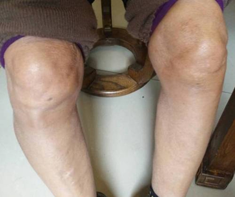 膝盖骨质增生 (39)