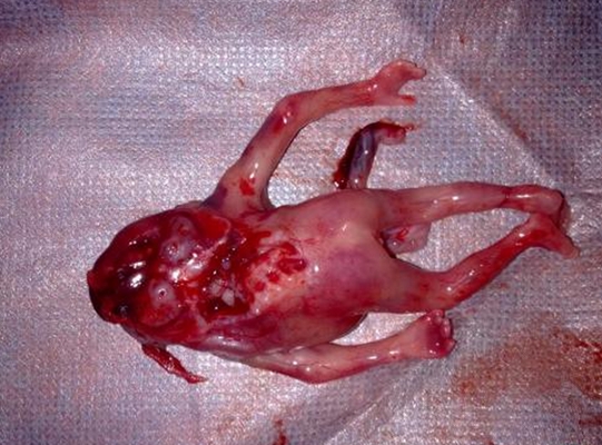 畸形胎儿真实图片