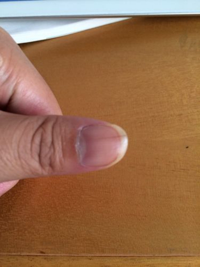 大拇指指甲上有竖纹 (44)