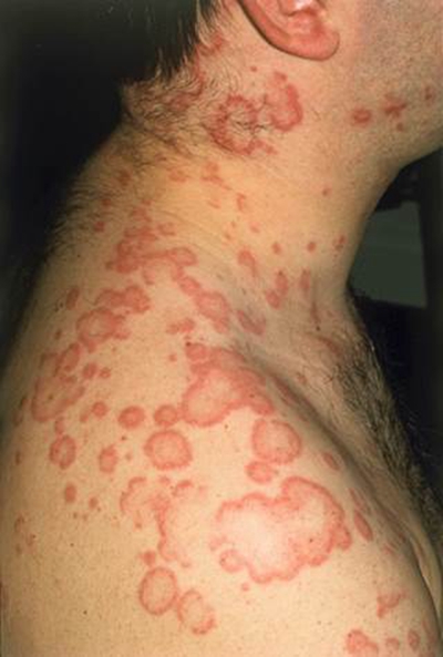 大人过敏性荨麻疹图片图片