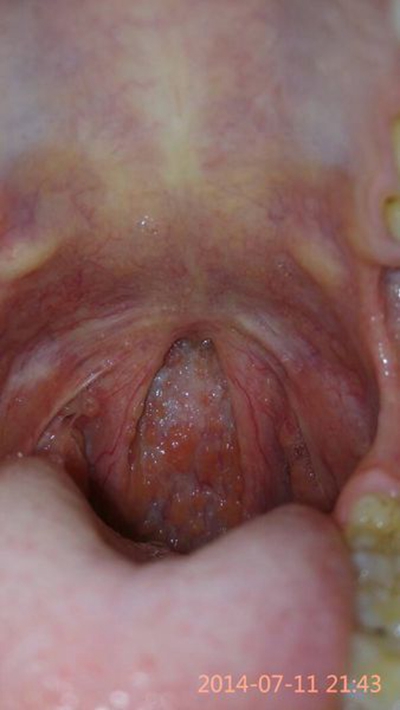 正常的咽喉炎图片图片