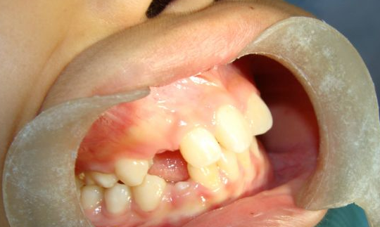 小孩牙龈癌的症状图片图片