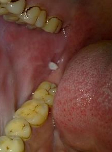 牙龈癌图片早期 初期图片