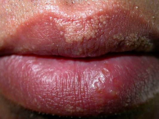嘴唇白斑是什么病图片