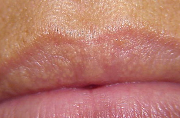 嘴唇白斑最初期的图片图片