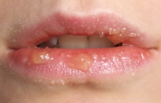 hpv嘴唇症状图片图片
