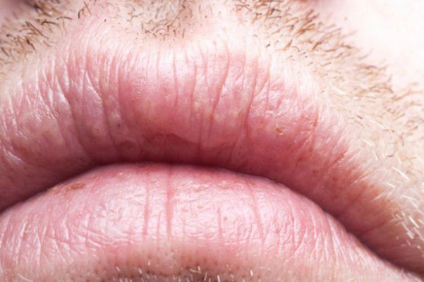 艾滋病人的嘴唇图片