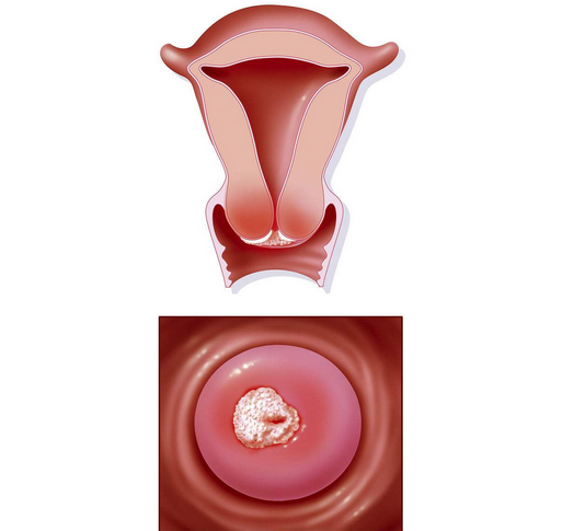 一度宫颈糜烂图片图片