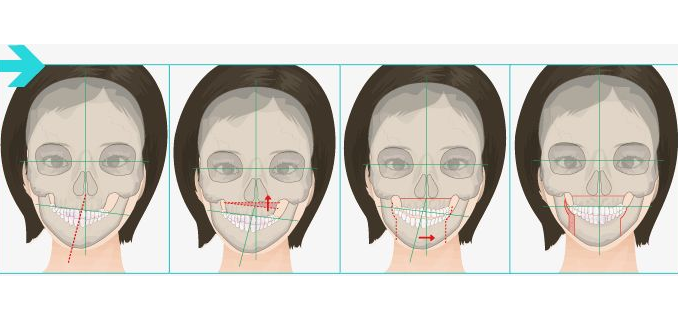 正颌手术 (1)