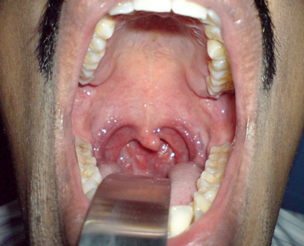 怎么看出喉咙发炎图片图片