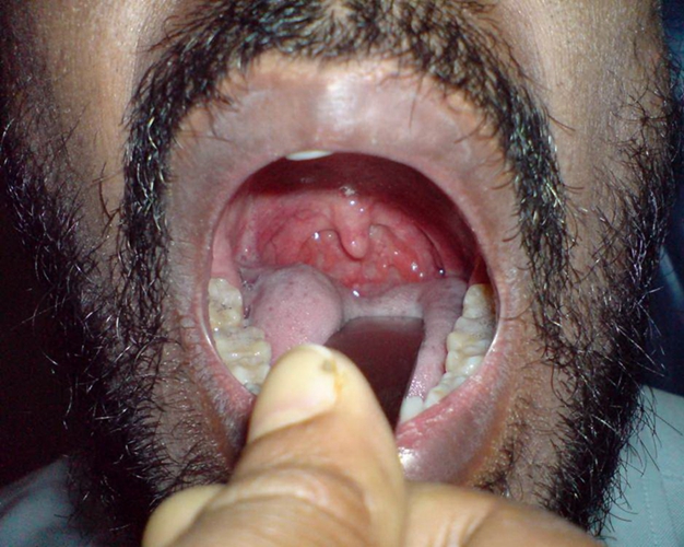 咽部充血严重图片图片