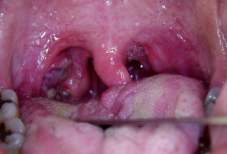 孕期急性咽炎的图片