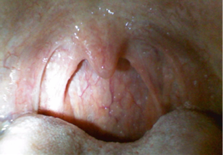 柯萨奇病毒急性喉炎末期症状的图片