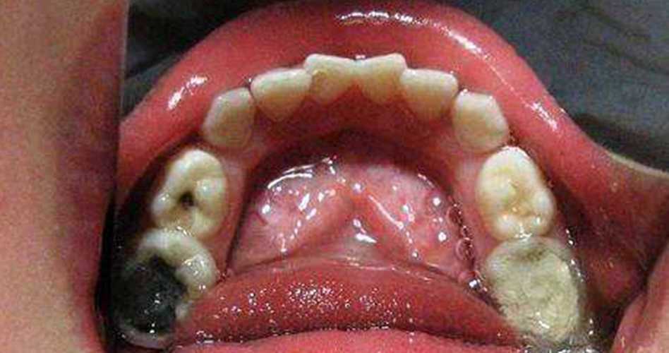 根尖牙周炎症状图片图片