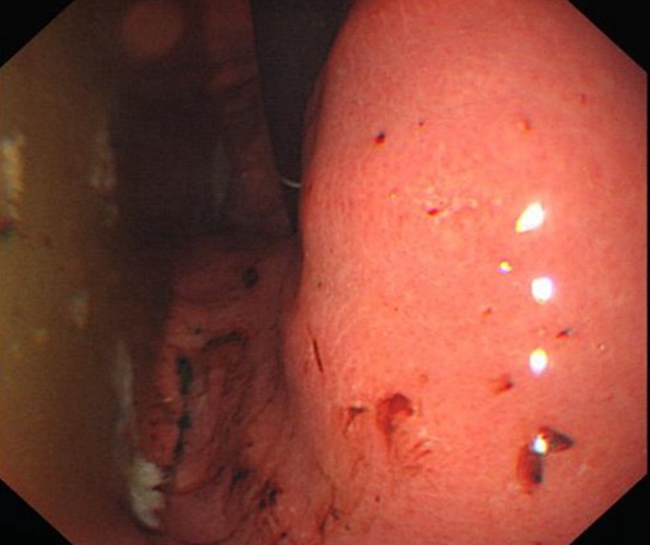 急性糜烂性的胃炎的充血的症状的图片