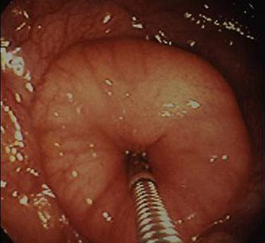 慢性结肠炎患者手术的图片