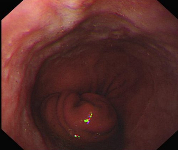 急性糜烂性胃炎的充血症状的图片