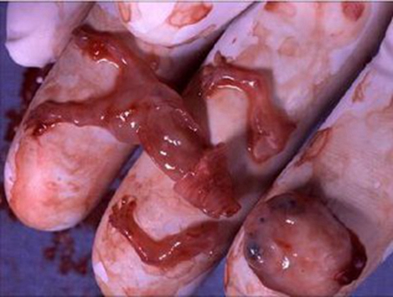 流产后胎囊图片男孩图片