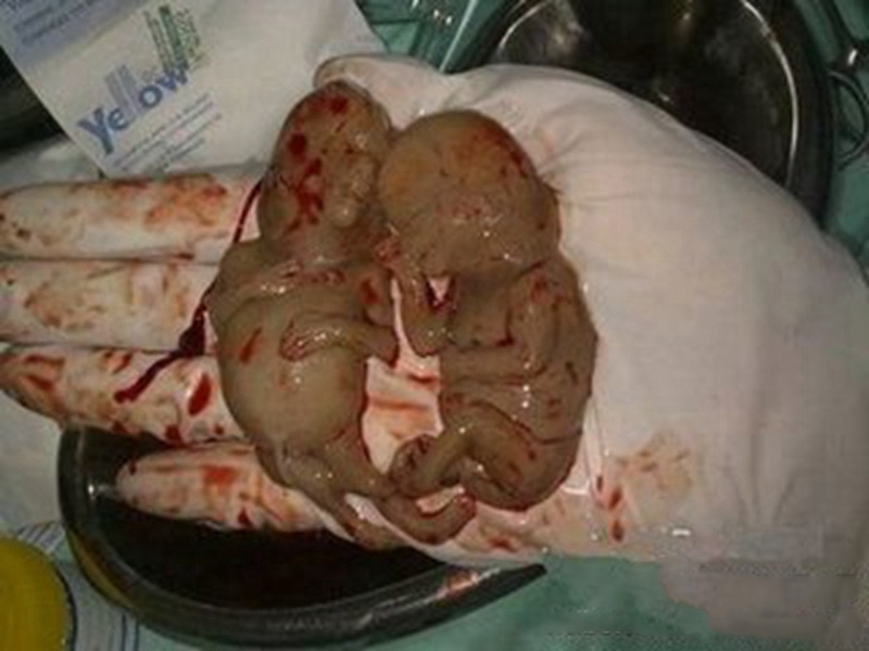 流产后胎囊图片男孩图片