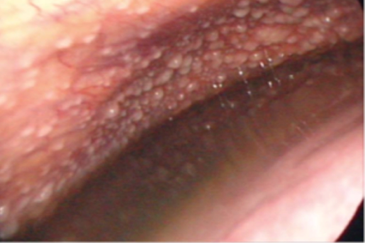 结核性胸膜炎的症状的图片