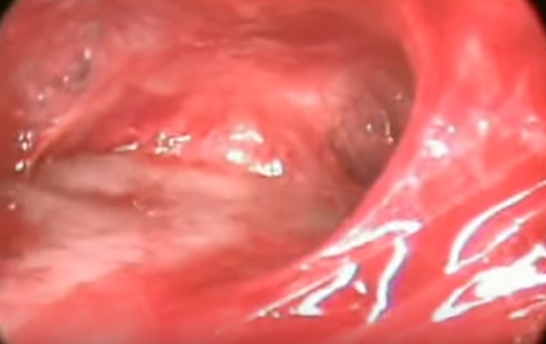 结核性胸膜炎红色的积液的图片