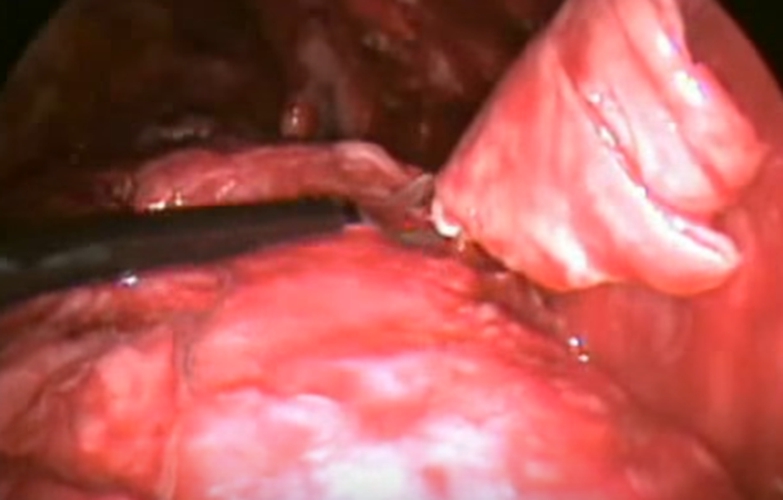 结核性胸膜炎手术过程的图片