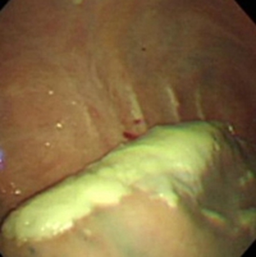 结核性胸膜炎早期的症状图片