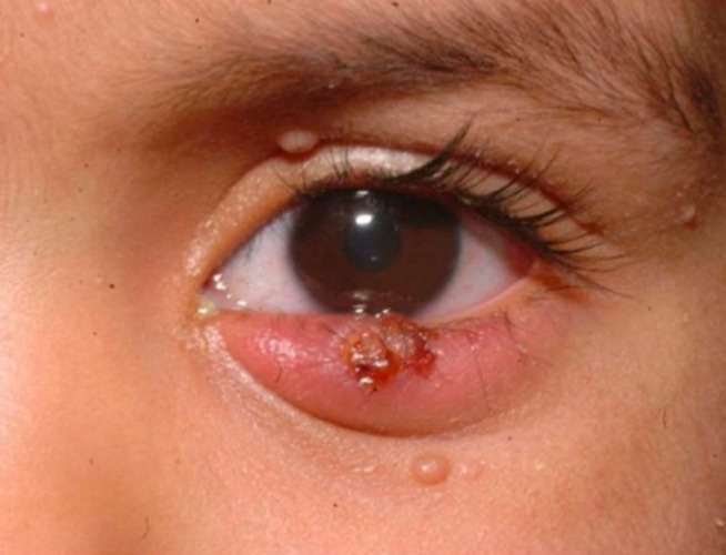 结膜炎早期症状图图片