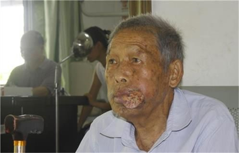老年男性颊癌图片