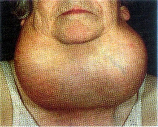 女性甲状腺癌的症状图片