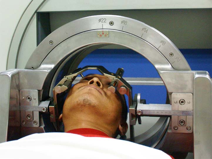 伽玛刀治疗良性脑膜瘤图片