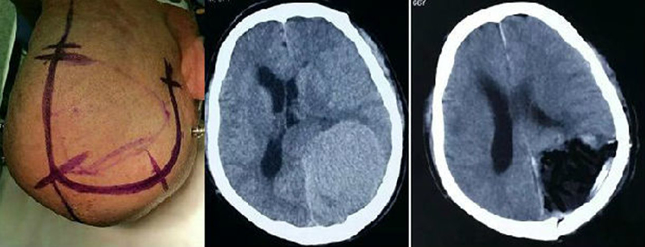 脑膜瘤症状CT图片
