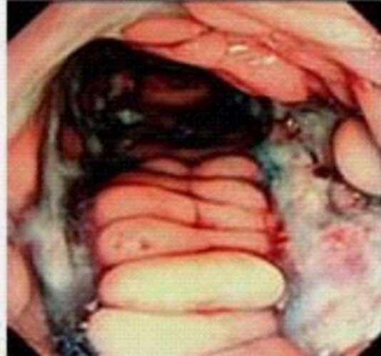 结肠的克罗恩病镜下的图片