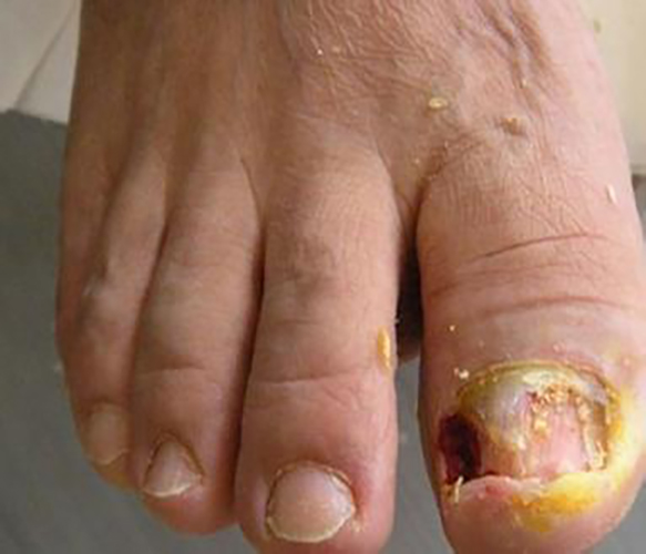 常见大脚趾甲沟炎的症状和图片