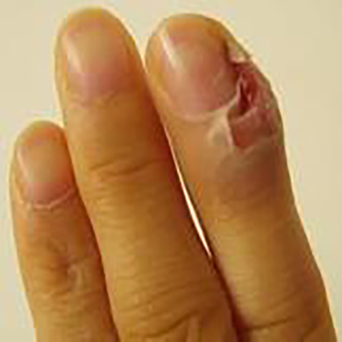 常见甲沟炎拇指的症状图片