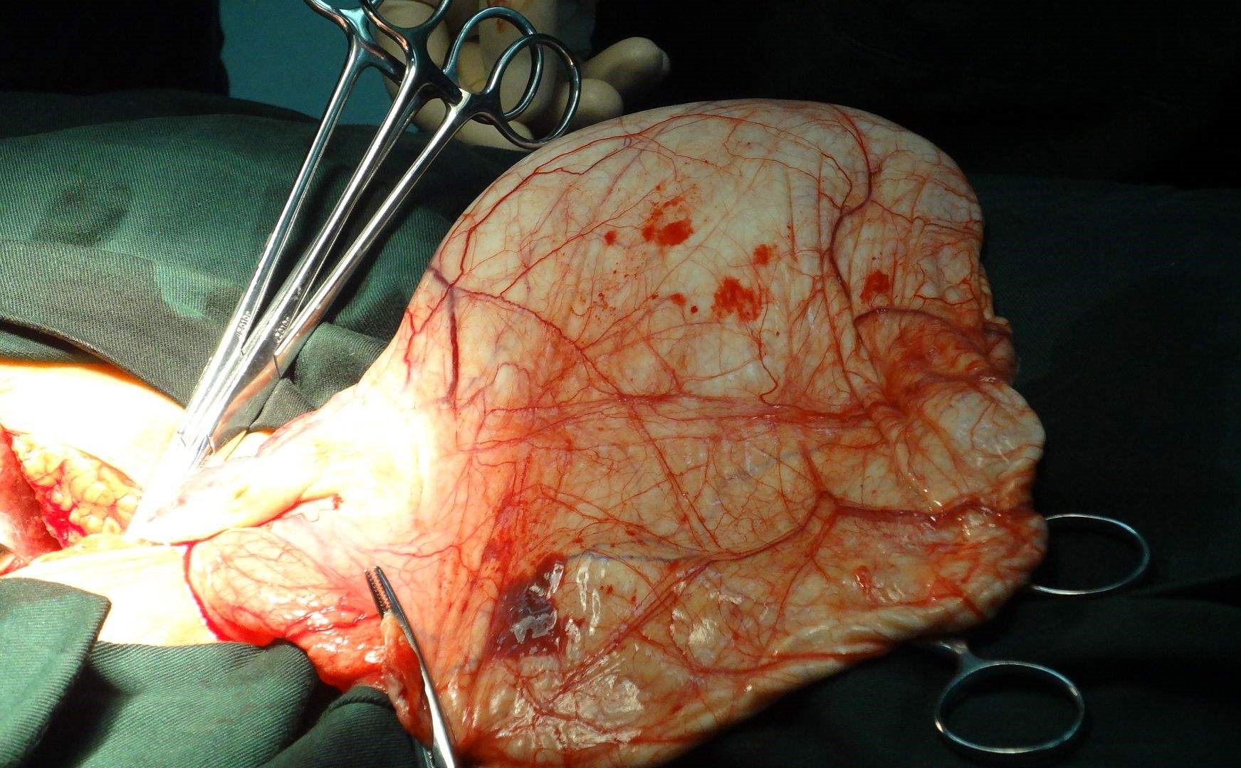 巨大卵巢囊肿根治手术图片