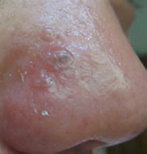 梅毒早期症状淋病图片