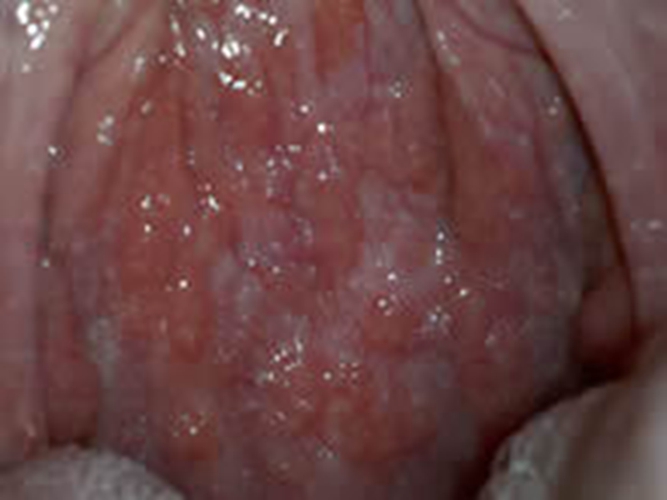 急性咽炎的末期症状图片