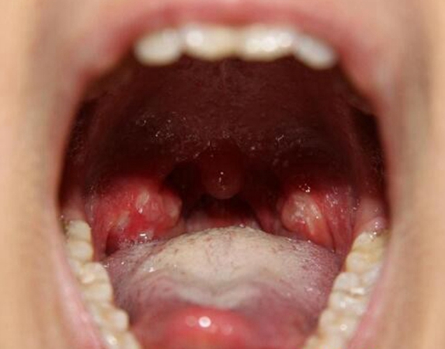 喉咙咽喉炎的症状图片图片
