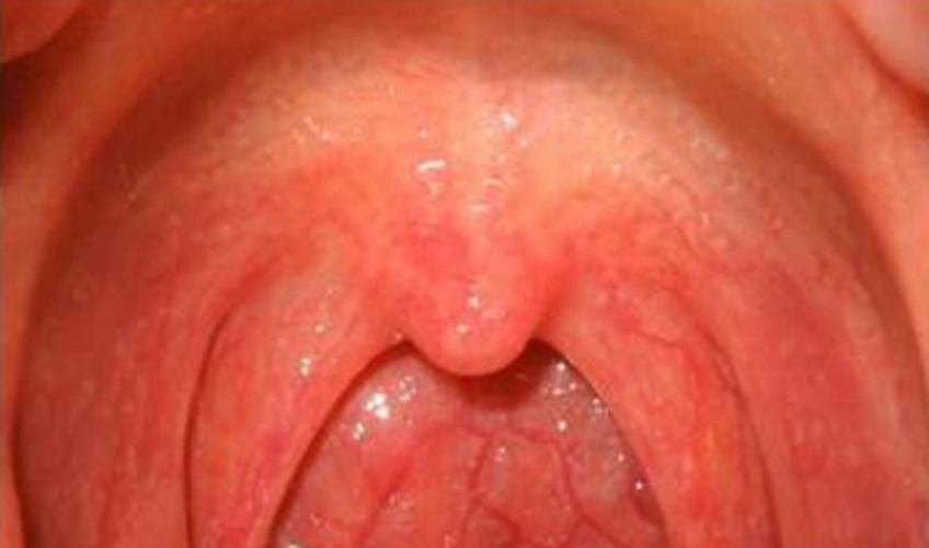 急性咽炎临床表现图片