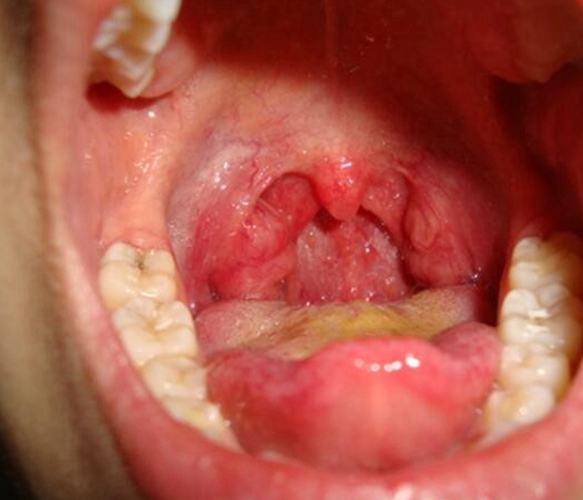 急性咽炎末期的症状的图片