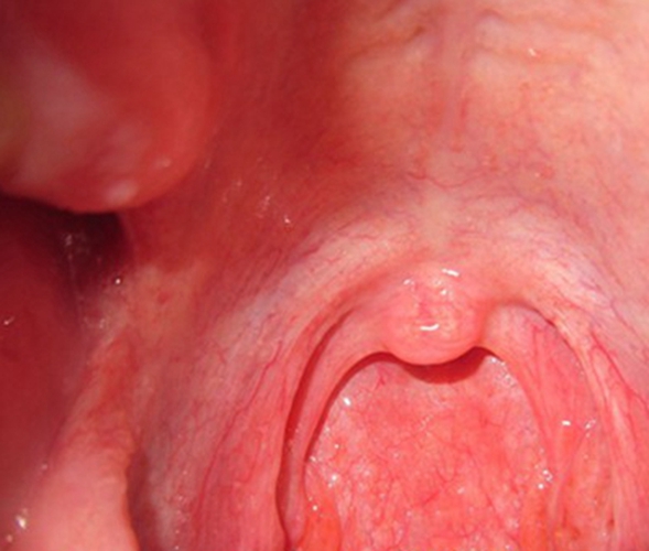 急性咽炎症状表现图片