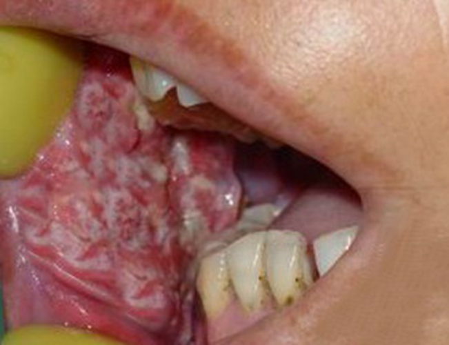 口腔癌肿瘤早期图片图片