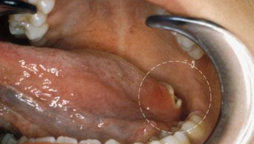 口腔癌图片早期图片
