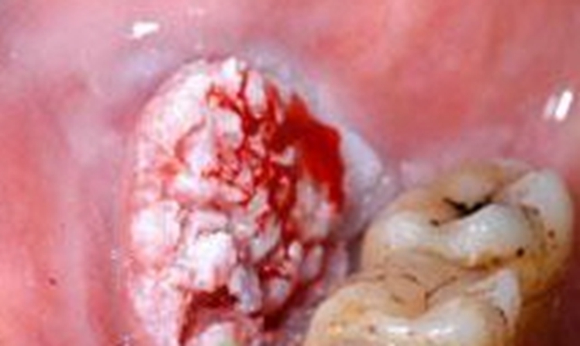 口腔癌的早期症状的图片