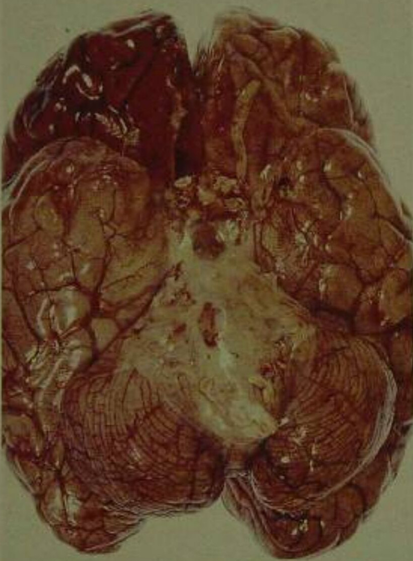 脑膜炎细菌性脑部图片