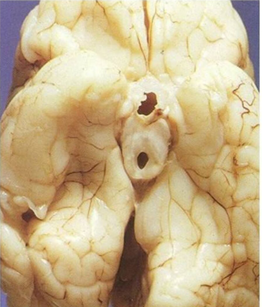 脑膜炎早期图片