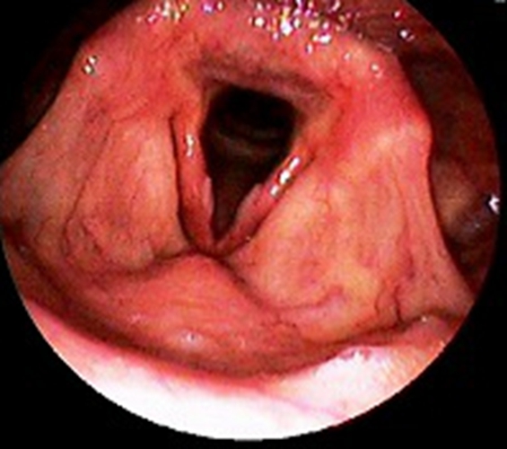 急性咽炎的主要的症状的图片